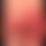 Differenzialdiagnose:&nbsp;Kontaktdermatitis toxische

Diagnose:&nbsp;&nbsp;Symmetrical drug rela...