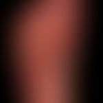 Differenzialdiagnose: "Dyshidrotische Dermatitis"

Diagnose: Psoriasis plantaris mit ausgeprägter...