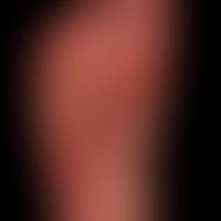 Differenzialdiagnose: "Dyshidrotische Dermatitis"

Diagnose: Psoriasis plantaris mit ausgeprägter...