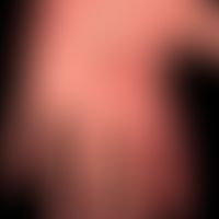 Psoriasis arthropathica: schmerzhafte Schwellung und Bewegungseinschränkung der Gelenke des Zeige...