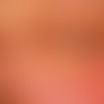Xanthelasma:&nbsp;die Hautläsionen entwickelten sich allmählich innerhalb der vergangenen 3-4 Jah...