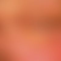 Xanthelasma:&nbsp;die Hautläsionen entwickelten sich allmählich innerhalb der vergangenen 3-4 Jah...