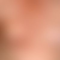 Lichen sclerosus et atrophicus: polytopischer extragenitaler + genitaler Befall (Brustregion)&nbs...