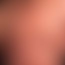 Erythrodermische Psoriasis: Seit Jahren bekannte Psoriasis. Seit mehreren Monaten allmähliche Aus...