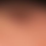 Keratose seborrhoische (papillomatöser Typ): seit Jahren bekannte, breit aufsitzende, nicht mehr ...