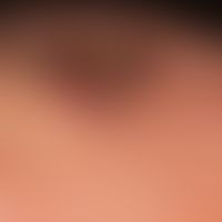 Keratose seborrhoische (papillomatöser Typ): seit Jahren bekannte, breit aufsitzende, nicht mehr ...