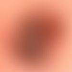 Basalzellkarzinom pigmentiertes: langsam wachsender,völlig symptomloser, scharf zur gesund Haut a...