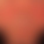 Rosacea erythematosa: flächige Rötung un Schwellung der Wangenregionen. Lidschwellungen
