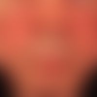 Differenzialdiagnose: Erysipel

Diagnose:&nbsp; Rosacea erythematosa, bds. chronische gleichmäßig...