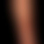 Syphilis: teils papulöses, teils-papulo-ulzeröses Syphilid.

