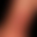 Syphilide: ulzeröses (fambösiformes)&nbsp;Syphilid (Teilmanifeststation bei generalisiertem Syphi...