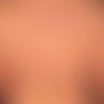 Fleck, rot:&nbsp; retikuläre,unscharf bgerenzte Flecken. Diagnose: Erythema e calore.
