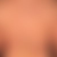 Fleck, rot:&nbsp; retikuläre,unscharf bgerenzte Flecken. Diagnose: Erythema e calore.
