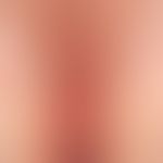 Lichen planus von Anus/Damm/Vulva: seit Monaten Juckreiz.&nbsp;&nbsp;42-jährige Patientin mit wei...