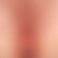 Lichen planus von Anus/Damm/Vulva: seit Monaten Juckreiz.&nbsp;&nbsp;42-jährige Patientin mit wei...