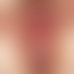 Lichen planus von Anus/Damm/Vulva: seit Monaten Juckreiz und Schmerzen.&nbsp; 52-jährige Patienti...