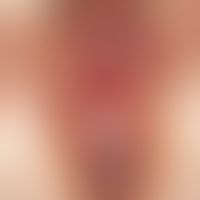 Lichen planus von Anus/Damm/Vulva: seit Monaten Juckreiz und Schmerzen.&nbsp; 52-jährige Patienti...