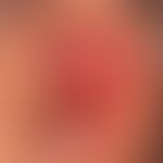 Keratoakanthom, klassischer Typ: kurzfristig, innerhalb von wenigen Wochen gewachsener, ca. 2,0&n...