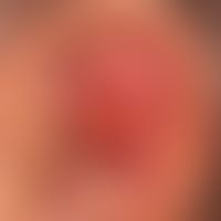 Keratoakanthom, klassischer Typ: kurzfristig, innerhalb von wenigen Wochen gewachsener, ca. 2,0&n...