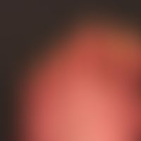 Psoriasis der Nägel: komplette Zerstörung der Nagelmatrix bei schwerer chronisch-aktiver (zeitwei...