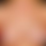 Sklerodermie zirkumskripte (PLaquetyp, progredientes Wachstum): Per Viereck gekennzeichnete, seit...
