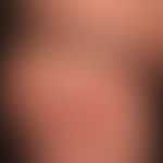 Enteritis regionalis, Hautveränderungen:&nbsp;chronische, granulomatöse,&nbsp;follikuläre und par...