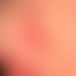 Enteritis regionalis, Hautveränderungen (Detailaufnahmen):&nbsp;chronische, granulomatöse,&nbsp;f...