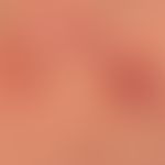 Enteritis regionalis, Hautveränderungen (Detailaunahmen):&nbsp;chronische, granulomatöse,&nbsp;fo...