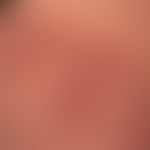 Enteritis regionalis, Hautveränderungen (Detailaunahmen):&nbsp;chronische, granulomatöse,&nbsp;fo...