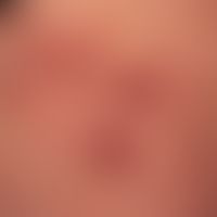 Enteritis regionalis, Hautveränderungen (Detailaunahmen):&nbsp;chronische, granulomatöse,&nbsp;fo...