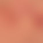 Enteritis regionalis, Hautveränderungen (Detailaunahmen):&nbsp;chronische, granulomatöse,&nbsp;fo...