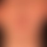 Parry-Romberg-Syndrom&nbsp;als Teilmanifestation einer generalisierten zirkumskripten Sklerodermi...