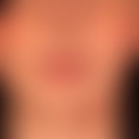 Parry-Romberg-Syndrom&nbsp;als Teilmanifestation einer generalisierten zirkumskripten Sklerodermi...