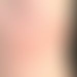 Parry-Romberg-Syndrom mit segmentaler Hautatrophie als Teilmanifestation einer multifokalen zirku...