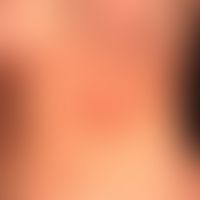 Parry-Romberg-Syndrom mit segmentaler Hautatrophie als Teilmanifestation einer multifokalen zirku...