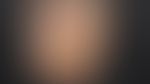 Onychogrypose: durch Dauerdruck bedingte Nagelverdickung.
