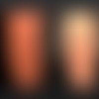 Lichen striatus (Verlaufskontrolle): Links-Ausgangsbefund; rechts Befund 5 Jahre später. Nahezu k...