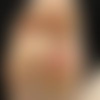 9jähriger Junge. Vor 2 Tagen plötzlicher Beginn mit starken Schmerzen plantar bds beim Auftreten....