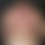 Differenzialdiagnose: Sklerodermie zirkumskripte

Diagnose: Lyme-Borreliose. Über mehrere Jahre l...