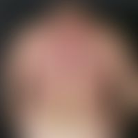 Differenzialdiagnose: Sklerodermie zirkumskripte

Diagnose: Lyme-Borreliose. Über mehrere Jahre l...