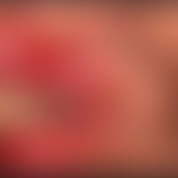Behçet, M.:&nbsp;seit etwa 10 Tagen persistierendes, &nbsp;aphthöses, weißliches, stark schmerzen...