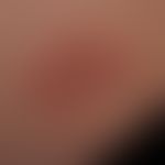 Pemphigoid gestationis:&nbsp;seit einigen Wochen bestehende, exanthematisch&nbsp;verteilte teils ...
