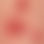 Pemphigoid gestationis:&nbsp;seit einigen Wochen bestehende, exanthematisch&nbsp;verteilte teils ...