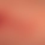 Pemphigoid gestationis:&nbsp;seit einigen Wochen bestehende, exanthematisch&nbsp;verteilte teils ...