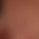 Pemphigoid gestationis:&nbsp;seit wenigen Wochen bestehende symmetrisch verteilte teils münzartig...
