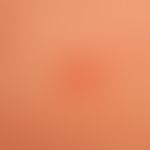 Pemphigoid gestationis:&nbsp;seit einigen Wochen bestehende, exanthematisch&nbsp;verteilte teils ...