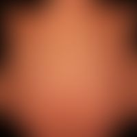Pemphigoid gestationis:&nbsp;seit wenigen Tagen bestehende exanthematisch verteilte teils münzart...
