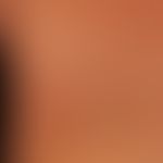 Pemphigoid gestationis:&nbsp;seit wenigen Wochen bestehende symmetrisch verteilte teils münzartig...