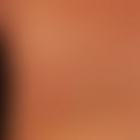 Pemphigoid gestationis:&nbsp;seit wenigen Wochen bestehende symmetrisch verteilte teils münzartig...
