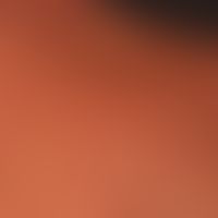Pustel: einzelne follikuläre(bakterielle)&nbsp;Pusteln.

